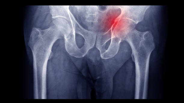 Film X ray fracture acetabulum