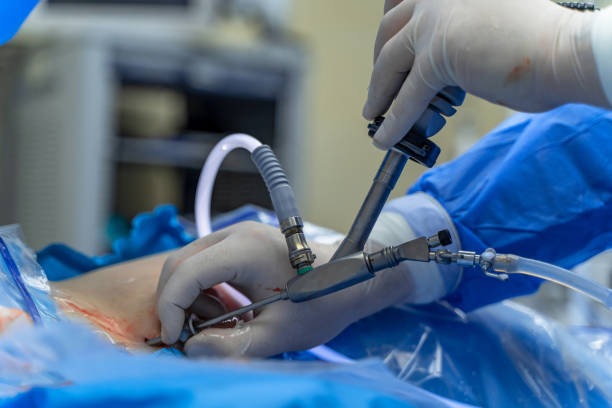 K-wire Removal