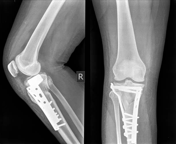 Open Reduction Dislocation